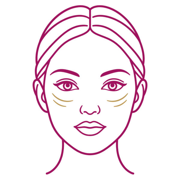 Illustration of a face marking cheek wrinkles for Sculptra collagen stimulation in London