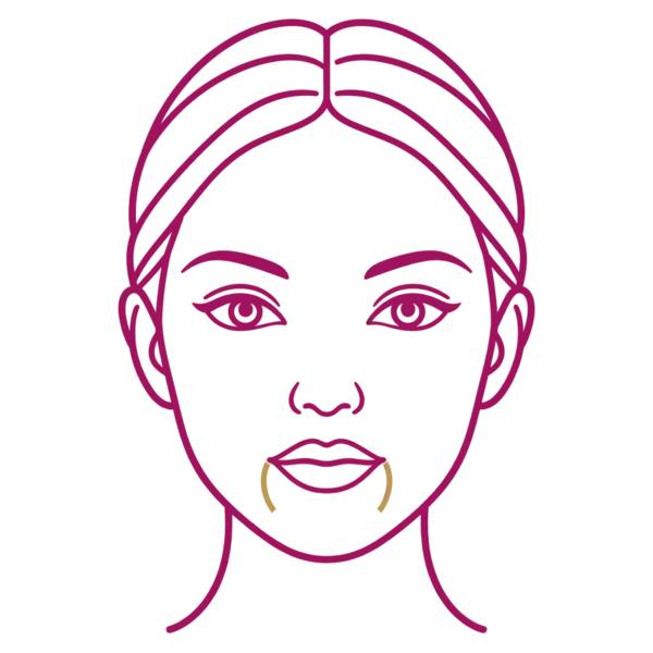 Illustration of a face marking marionette lines for Sculptra collagen stimulation in London