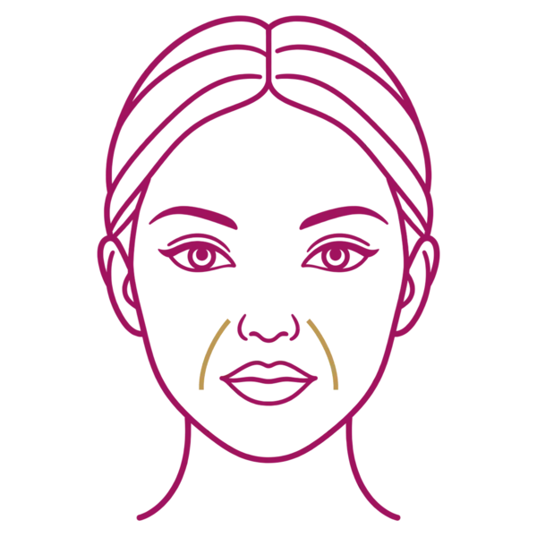Illustration of a face marking smile lines for Sculptra collagen stimulation in London